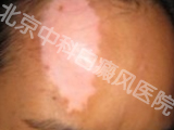 北京中科白癜风医院